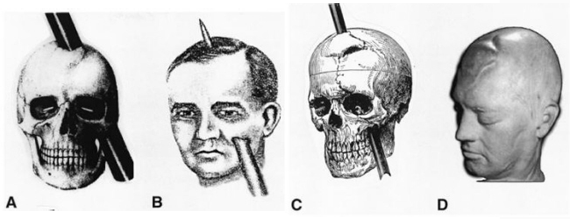 Phineas Gage